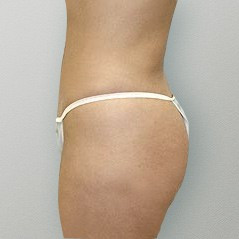 Tummy Tuck after — Dr. Howard Gross