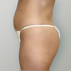 Tummy Tuck before — Dr. Howard Gross