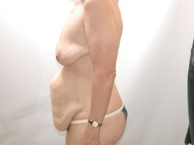 Tummy Tuck before — Dr. Howard Gross