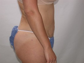 Liposuction before and after - after