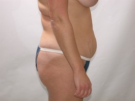Liposuction before and after - before