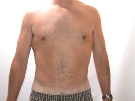 Liposuction before and after - after