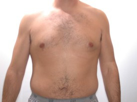 Liposuction before and after - before