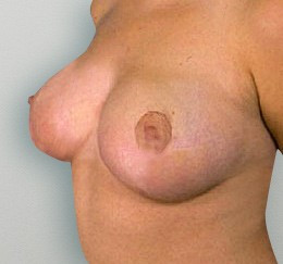 Breast Reduction before and after - after