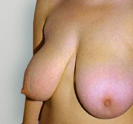 Breast Reduction before and after - before