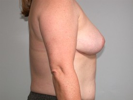 Breast Reduction before and after - after