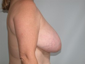 Breast Reduction before and after - before