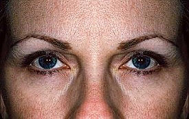 Botox Treatments before and after - after