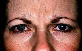 Botox Treatments before and after - before