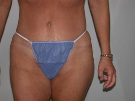 Tummy Tuck before and after - after