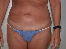 Tummy Tuck before and after - before