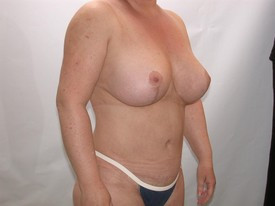 Breast Lift before and after - after