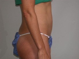 Liposuction after — Dr. Howard Gross
