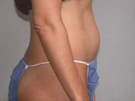 Liposuction before — Dr. Howard Gross