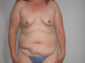 Tummy Tuck before — Dr. Howard Gross