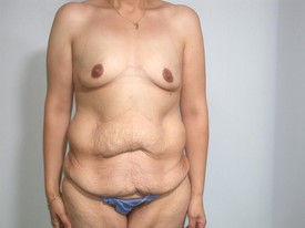 Body Lift before and after - before