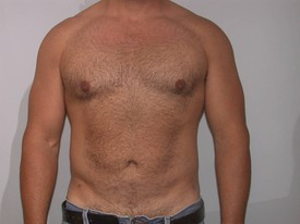 Liposuction after — Dr. Howard Gross