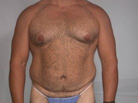 Liposuction before — Dr. Howard Gross
