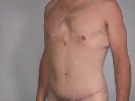Body Lift before and after - after
