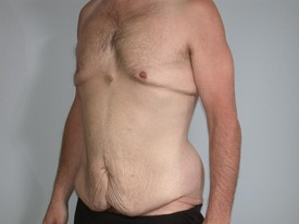 Body Lift before and after - before
