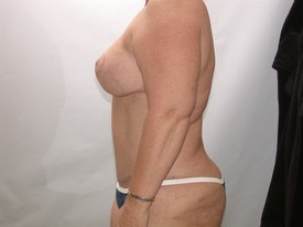 Tummy Tuck before and after - after