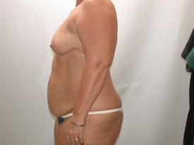 Tummy Tuck before and after - before