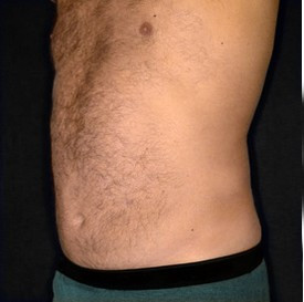 Liposuction after — Dr. Howard Gross