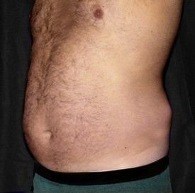 Liposuction before — Dr. Howard Gross