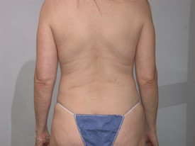 Liposuction before and after - after