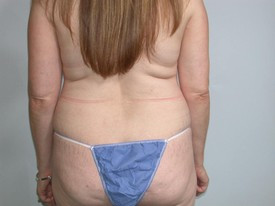 Liposuction before and after - before