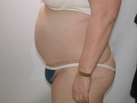 Tummy Tuck before and after - after