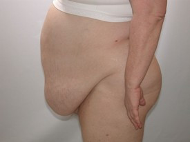 Tummy Tuck before and after - before