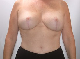 Breast Reduction before and after - after