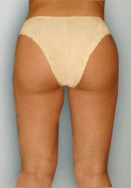 Liposuction before and after - after
