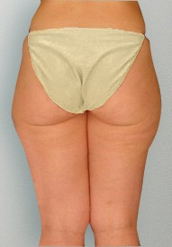Liposuction before and after - before