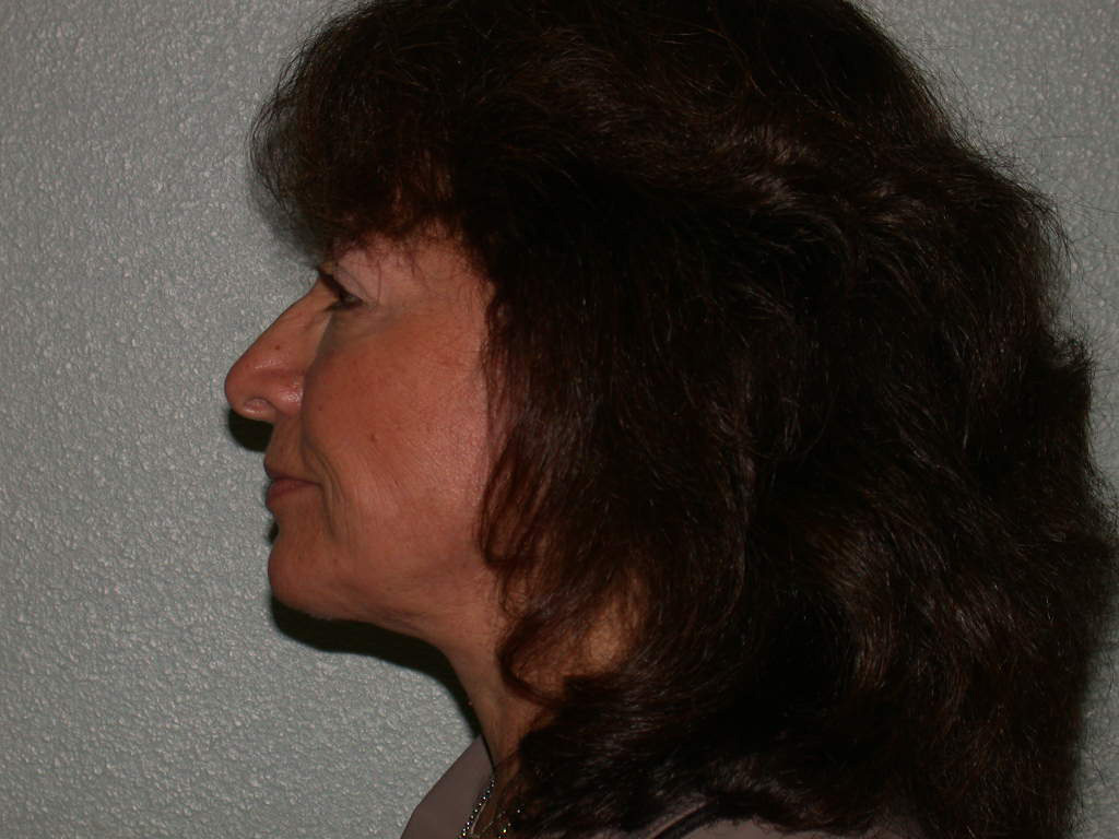 Chin and Cheek Implants before and after - after