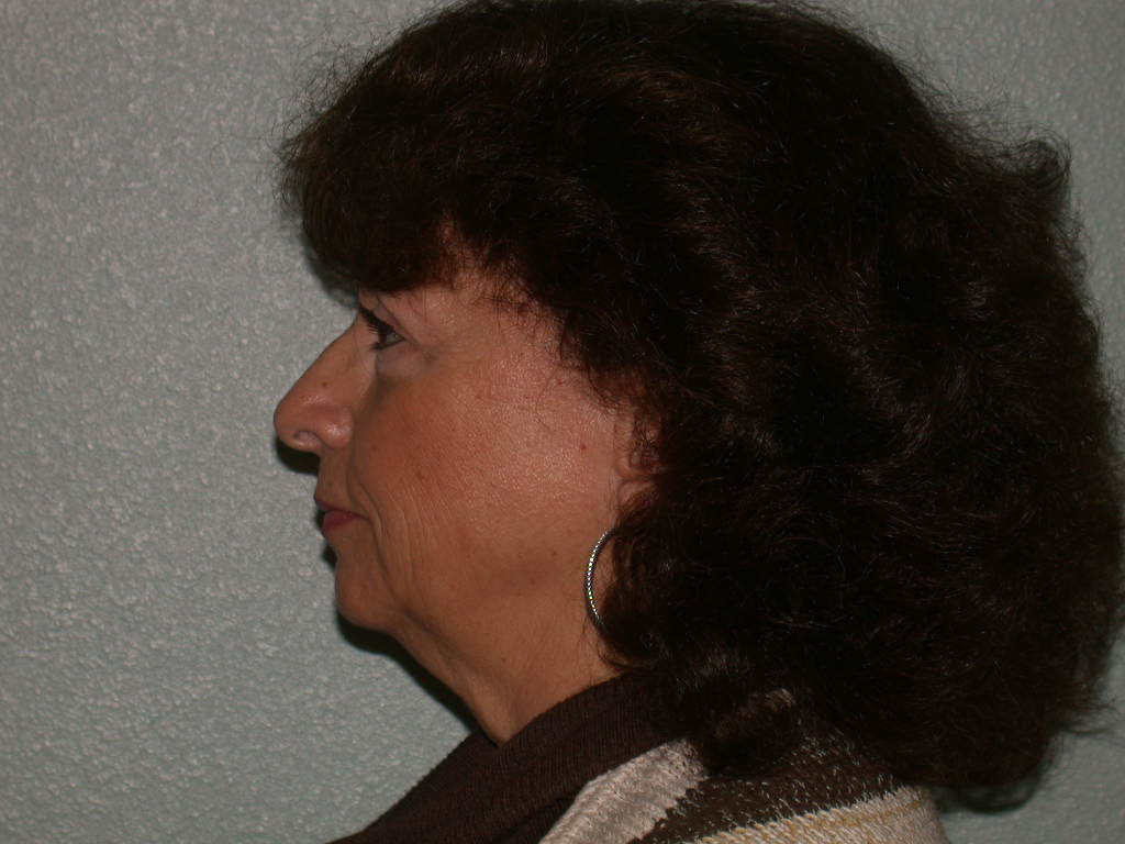 Chin and Cheek Implants before and after - before