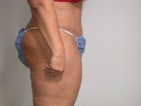 Tummy Tuck after — Dr. Howard Gross