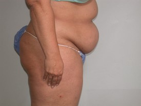 Tummy Tuck before — Dr. Howard Gross
