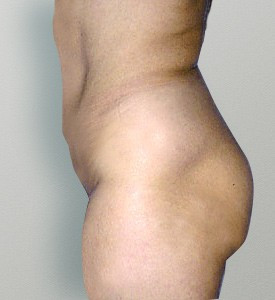 Tummy Tuck after — Dr. Howard Gross