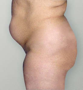 Tummy Tuck before — Dr. Howard Gross