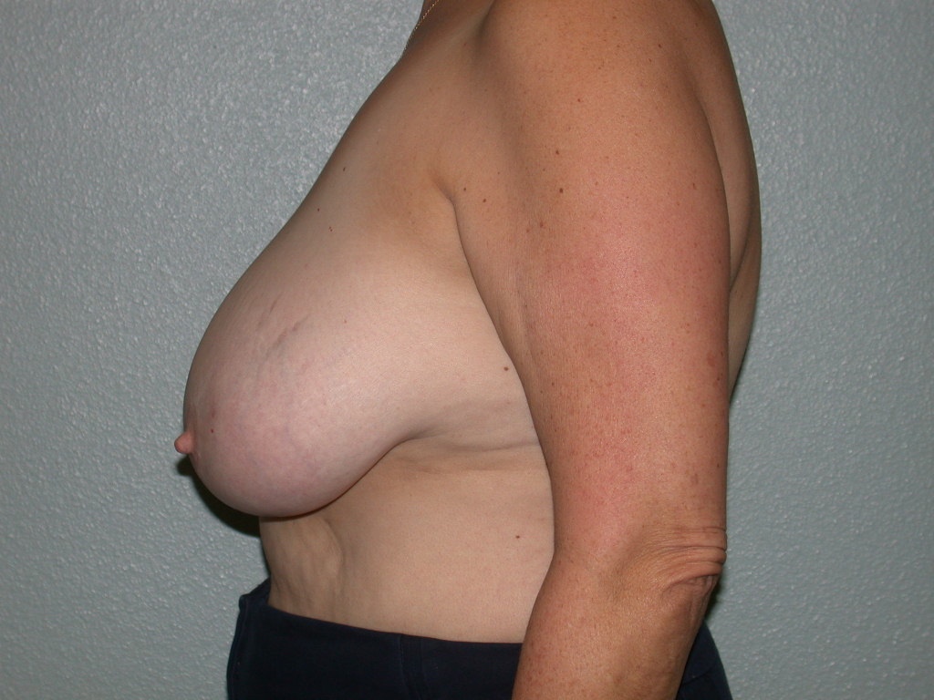 Breast Lift before and after - before