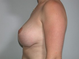 Breast Lift before and after - after