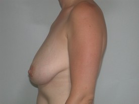 Breast Lift before and after - before