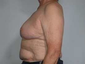 Breast Reduction before and after - after