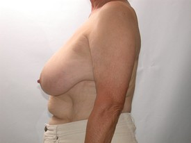 Breast Reduction before and after - before