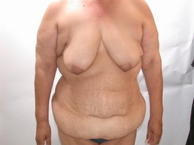 Tummy Tuck before — Dr. Howard Gross