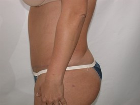 Tummy Tuck after — Dr. Howard Gross