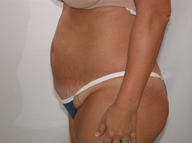 Tummy Tuck before — Dr. Howard Gross