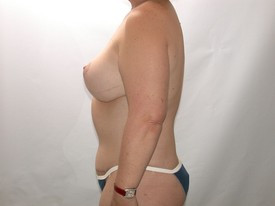 Tummy Tuck before and after - after